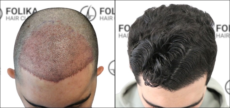 Antes-Despues-de-Trasplante-Capilar-en-Madrid-de-2700-Injertos-Clinica-Capilar-Folika-Hair-Clinic-8