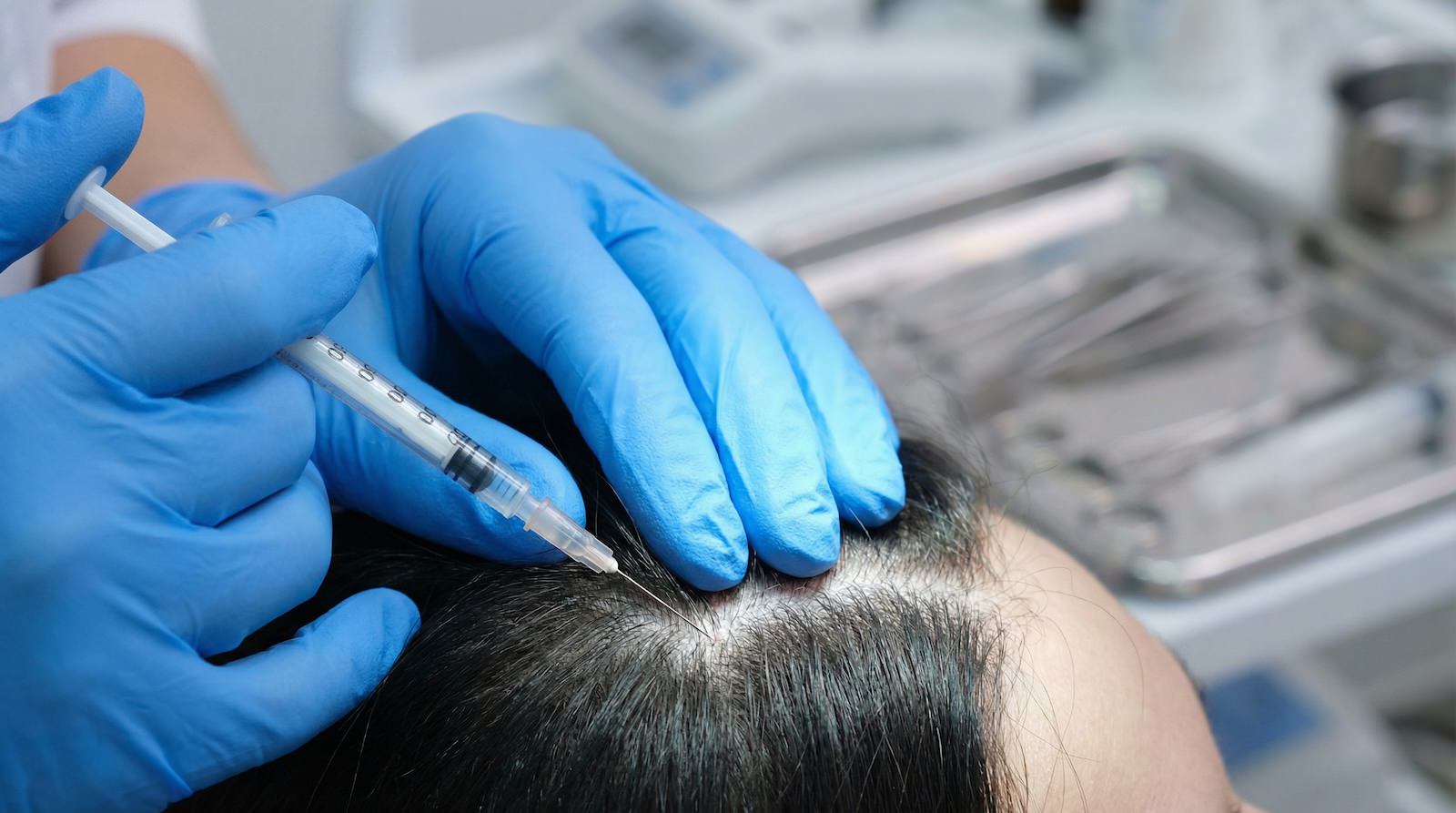 Primer plano de doctor especialista realizando una microinyección manual de mesoterapia capilar en el cuero cabelludo de un paciente en una clínica de Madrid.