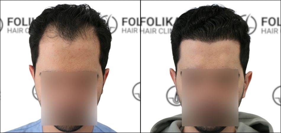 Injerto Capilar en Madrid para recuperar el pelo - Foto Antes Después de 2700 Injertos - Clínica Capilar en Camberí - Folika Hair Clinic