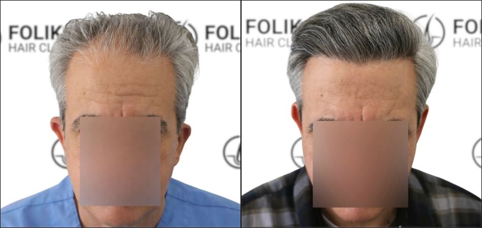 Injerto Capilar en Madrid para recuperar el pelo - Foto Antes y Despues de 2400 Injertos en frontal - Clínica Capilar en Camberí - Folika Hair Clinic