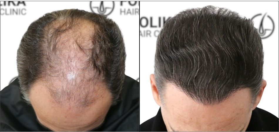 Injerto Capilar en Madrid para recuperar el pelo - Foto Antes y Después de 3284 Injertos - Clínica Capilar en Camberí - Folika Hair Clinic